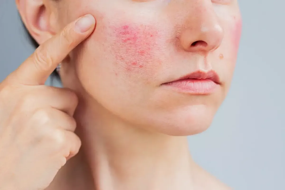 Kas ir rozācija? Simptomi un cēloņi Kas ir rozācija? Simptomi un cēloņi