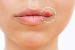Kas ir herpes vīruss? Kādi ir simptomi un ārstēšana?