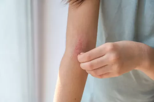 Atopiskais dermatīts: simptomi un ādas kopšana | Moonmart