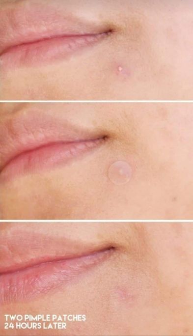 HOLIKA HOLIKA AC MILD Red Spot Patch plāksteris pumpām, 12 gab. - 3